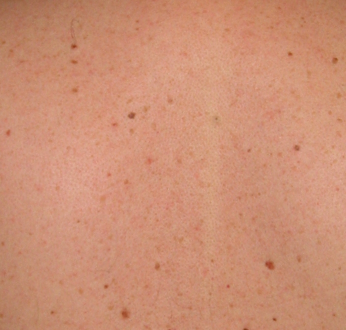 Typical back with moles